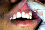 Apicectomy 1