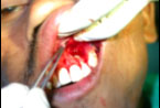 Apicectomy 2