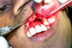 Apicectomy 3