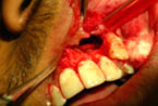 Apicectomy 4