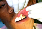 Apicectomy 5